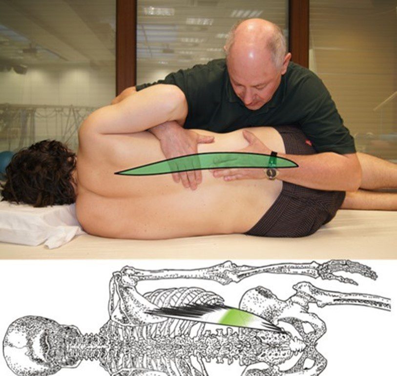 Behandling av diskbråck genom Spiral stabilisering och traktion.