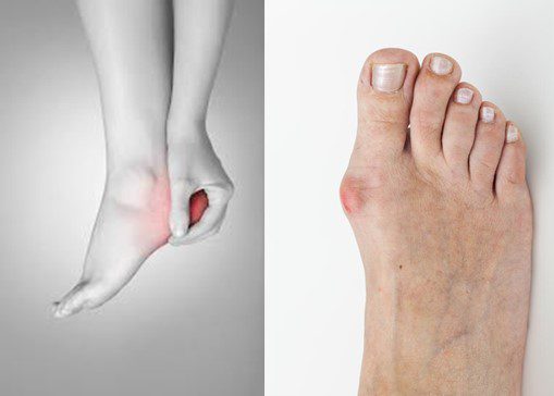Visar hälsmärta och Hallux valgus