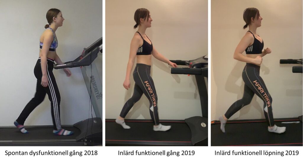 Skoliospatient i 3 bilder som jämför progress från dysfunktionell gång till funktionell löpning