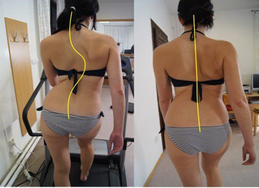 Kvinna med skolios gåendes avslappnat på ett gångband jämfört med att aktivt gående med aktivare sps. Effekt av träning vid skolios med Spiral stabilisering före och efter