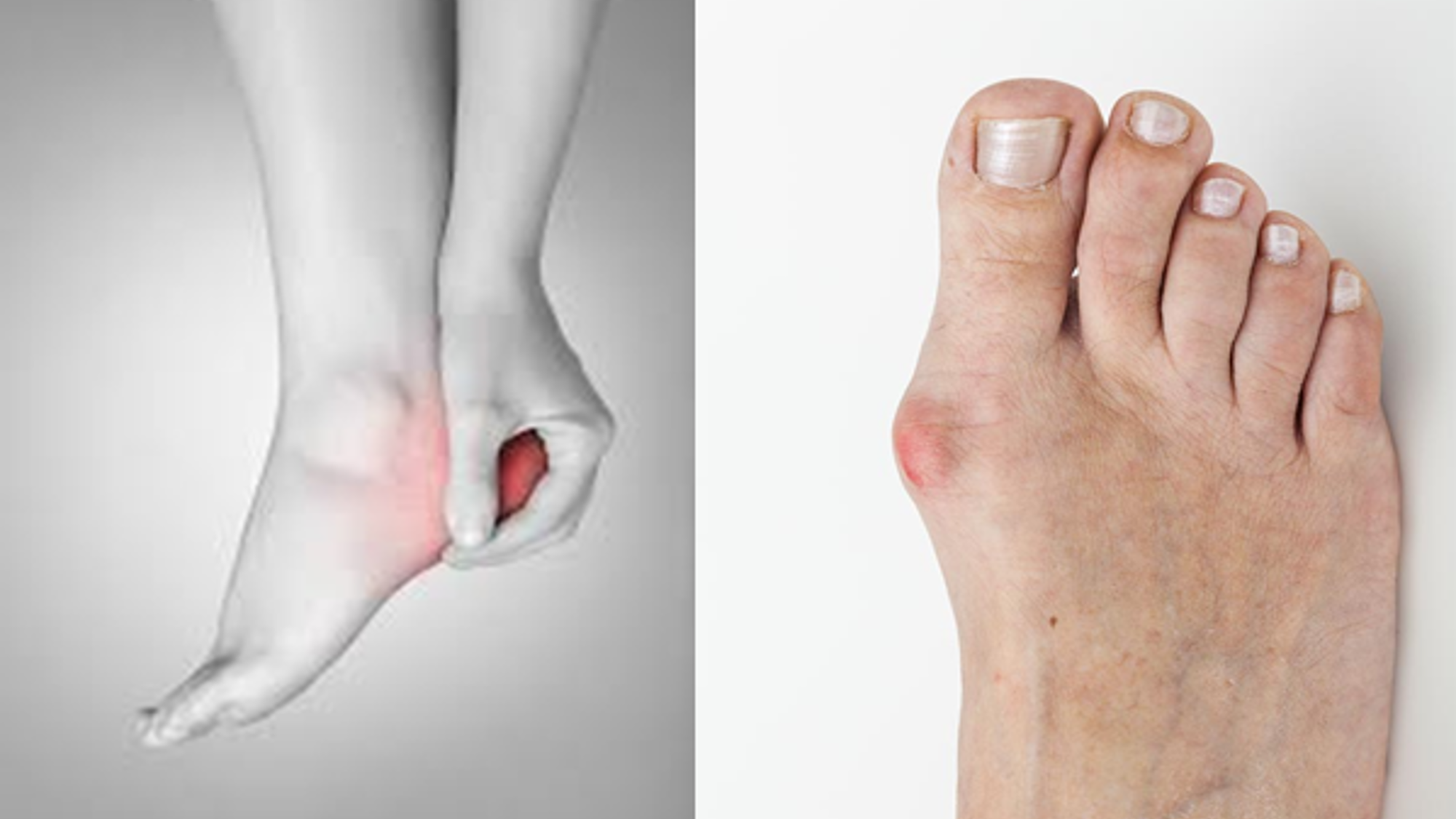 Visar ömmande häl och en fot med Hallux Valgus